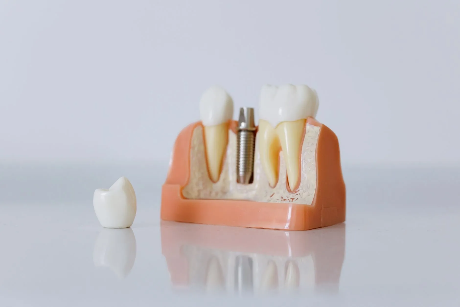 A cut-away model of an implant between two natural teeth, with its crown beside it