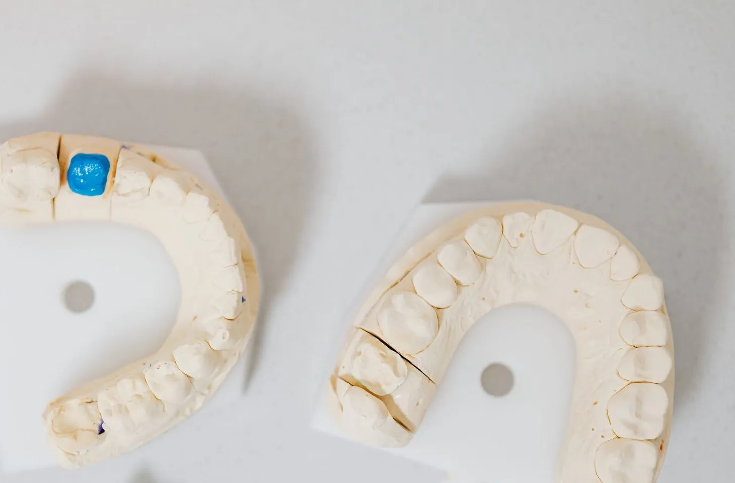 Two plaster models of upper and lower teeth, one with a tooth marked in blue